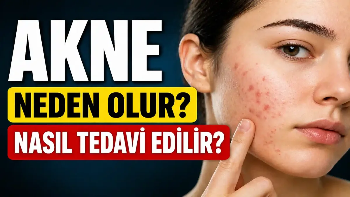 Akne Neden Oluşur, Nasıl Tedavi Edilir?