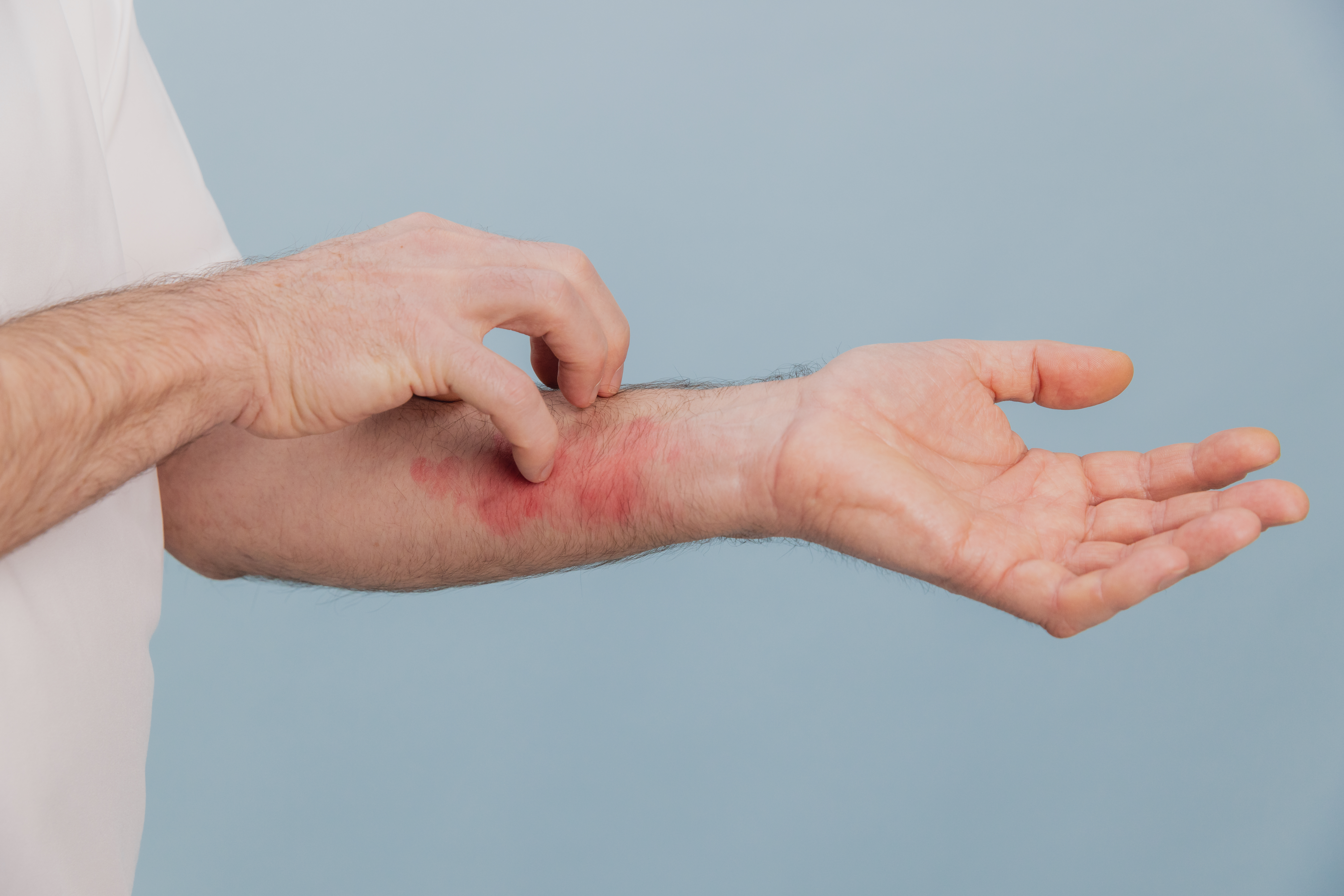 Arı Sokmasına Ne İyi Gelir? Arı Sokması Nasıl Geçer?