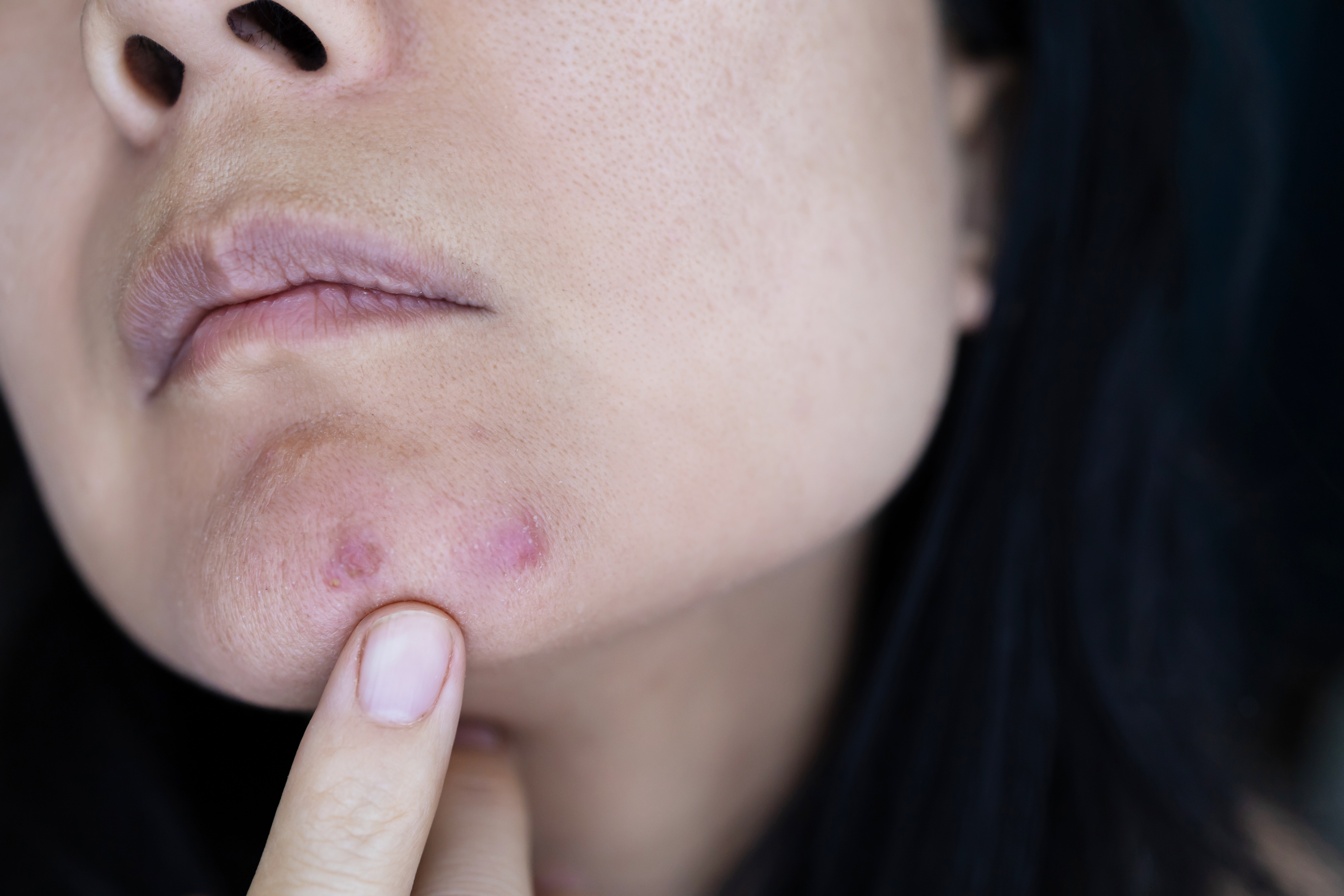 Çenede Sivilce Neden Çıkar? Hormonal, Stres ve Beslenme Kaynaklı Nedenler
