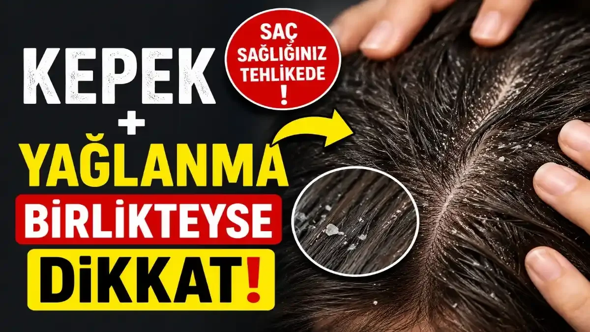 Kepek, Kaşıntı ve Saç Dökülmesi Birlikteyse Dikkat: Sebebi Sandığınızdan Farklı Olabilir