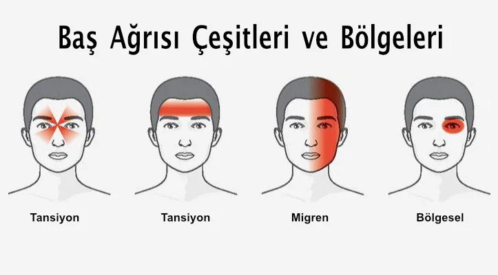 Migren, Sinüzit Ve Baş Ağrısını Ayırt Etmenin Yolları
