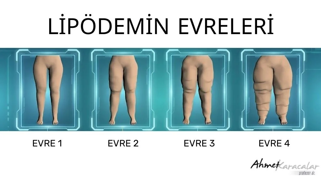 Prof. Dr. Karacalar Uyardı: Kilo Verememenin Nedeni Lipödem Olabilir