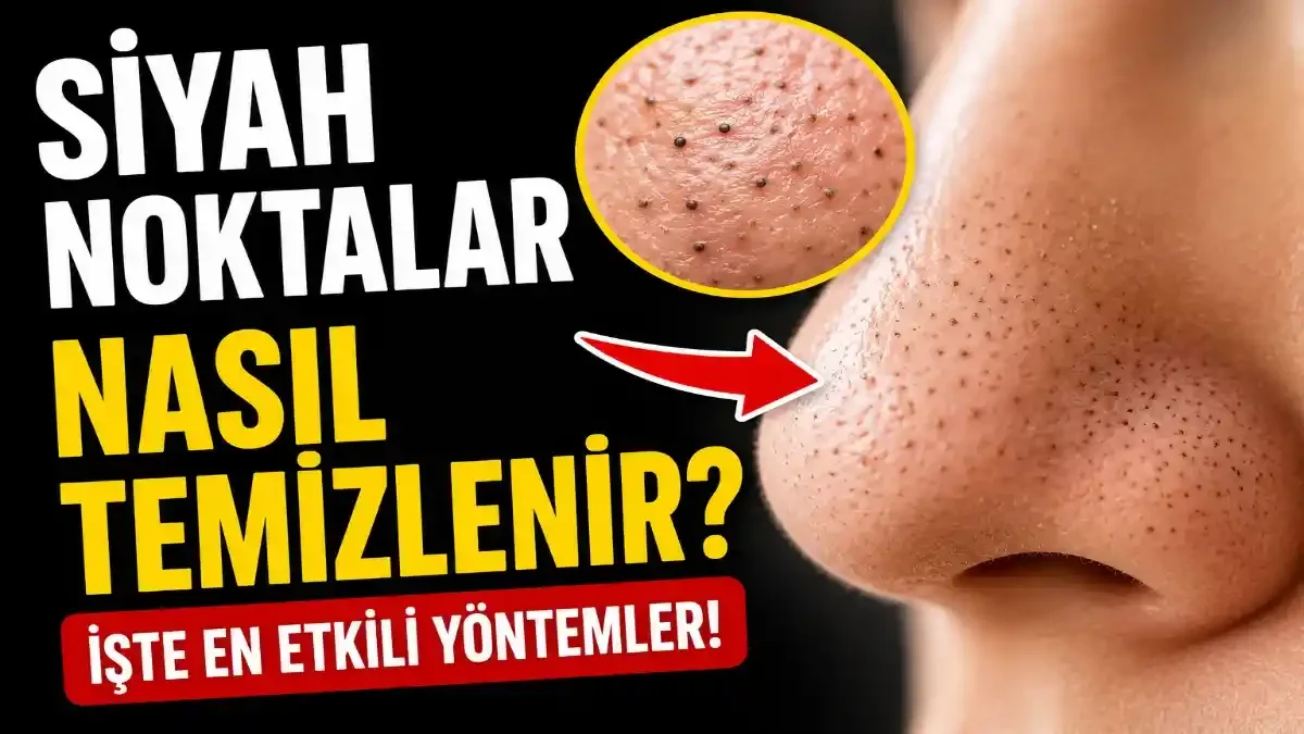 Siyah Noktalar Nasıl Temizlenir? Uzmanlardan Cilt Rehberi