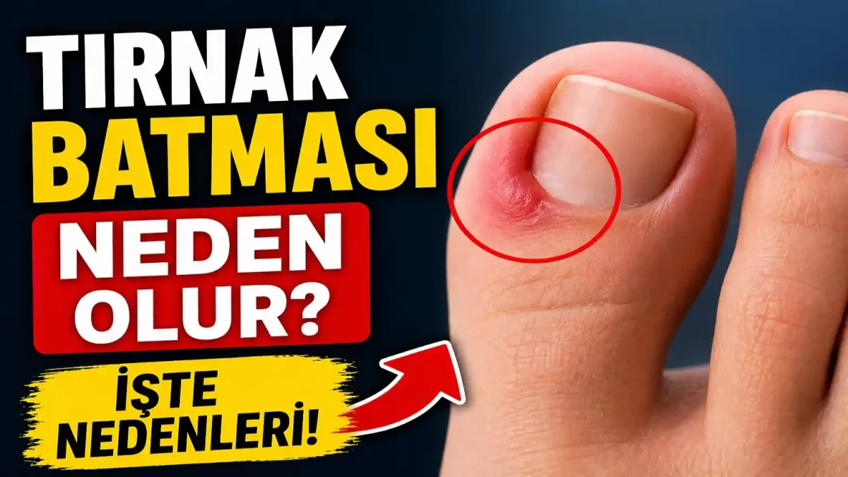 Tırnak Batması Neden Olur? Belirtileri, Risk Faktörleri Ve Doğru Önlemler