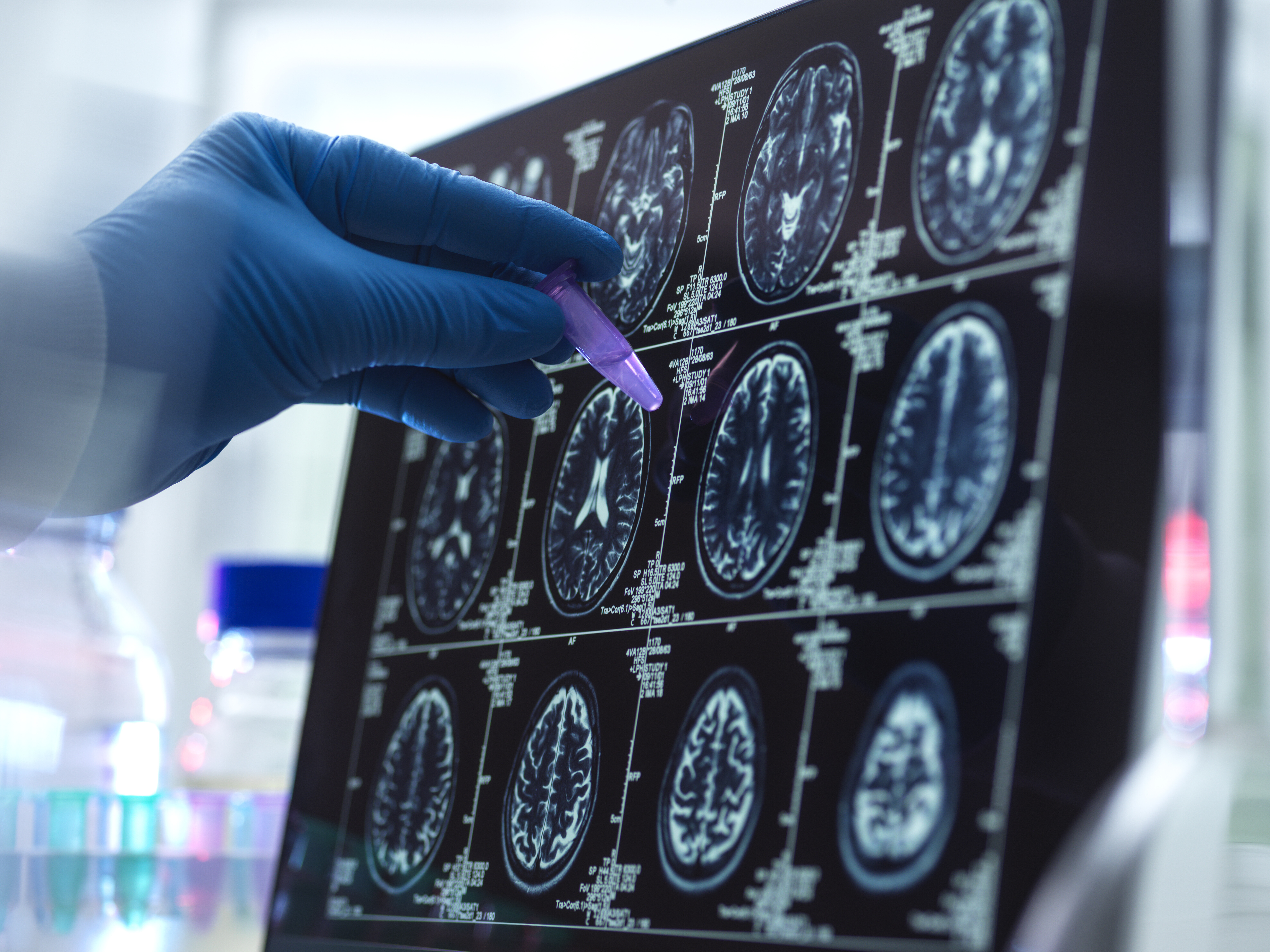 Yapay Zeka ile Erken Alzheimer Tespiti